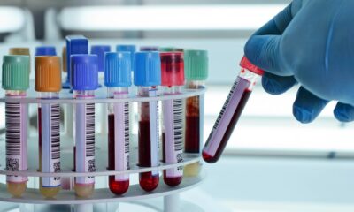 Campioni per analisi del sangue