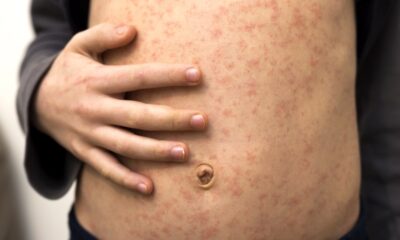 Bambino con il morbillo