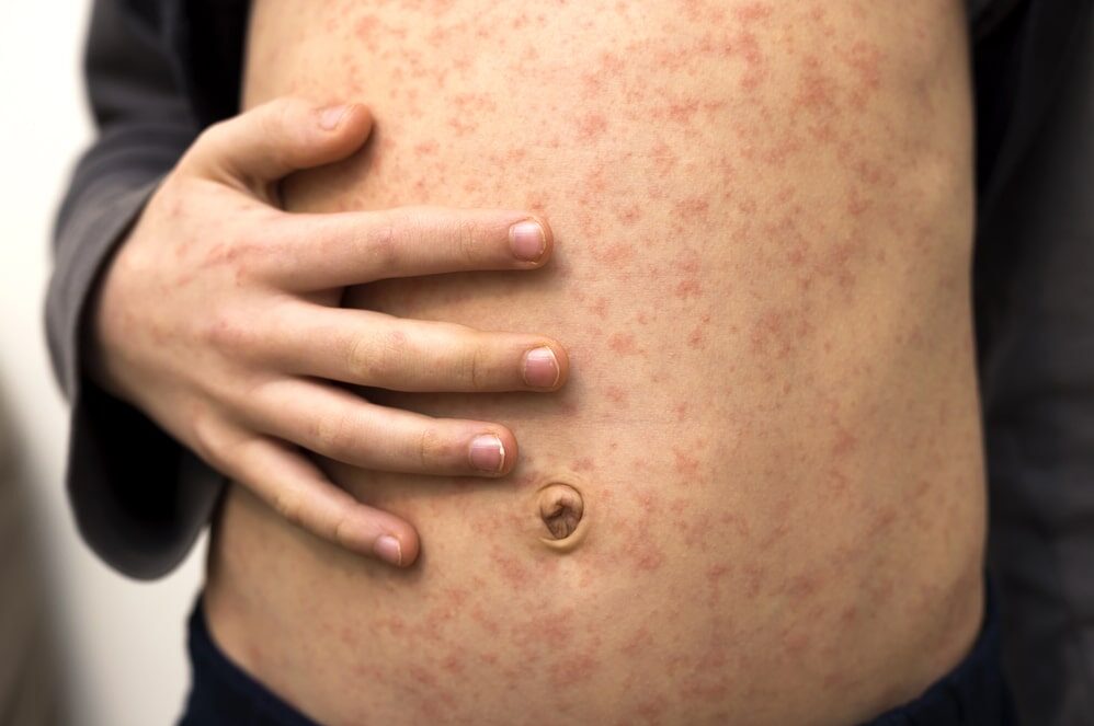 Bambino con il morbillo